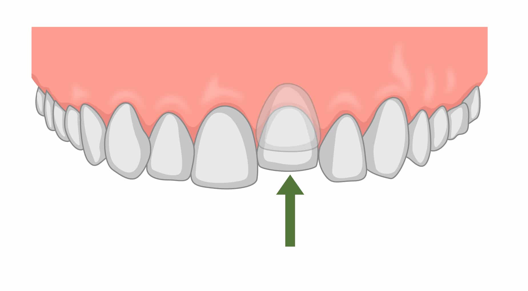دندان فک جوش (آنکیلوز دندان)